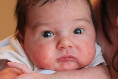 Photo of Младенцы, которые получают препараты для снижения желудочной кислотности, чаще зарабатывают аллергию в детском возрасте.