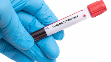 Photo of Тромбоцитопения: причины, степени, симптомы, лечение