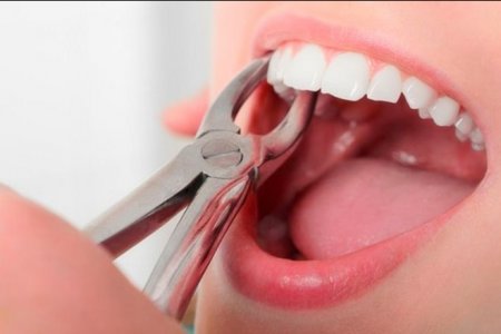 Photo of Как ускорить процесс заживления после удаления зуба