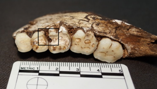 Photo of Сахар ни при чем: у наших древних предков были такие же проблемы с зубами